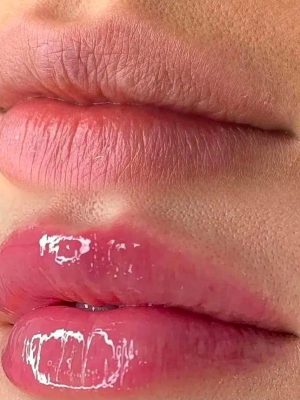 Dermapen