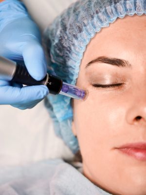 Láser azul para quitar imperfecciones
