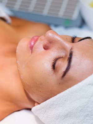Peeling Químico